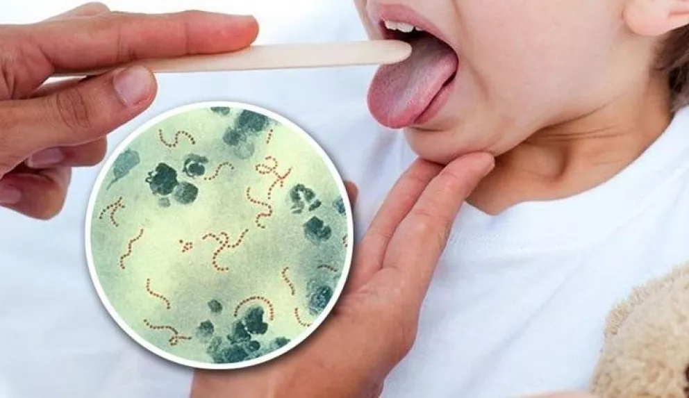 En esta nota, todo lo que tenés que saber de la bacteria Streptococcus pyognes